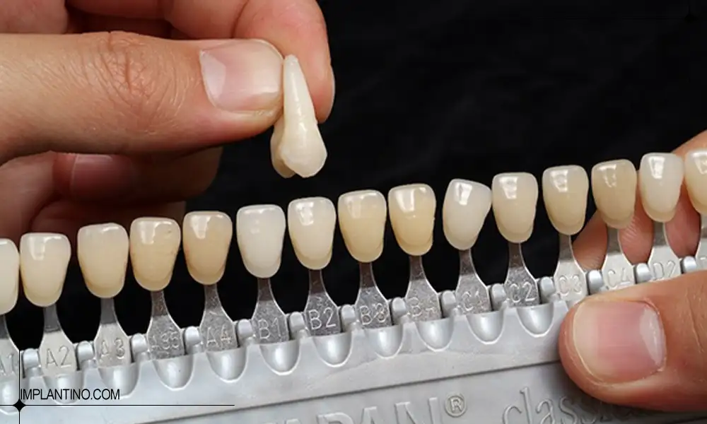 انتخاب رنگ کامپوزیت دندان برای زیبایی لبخند 1 ترتیب رنگ کامپوزیت دندان