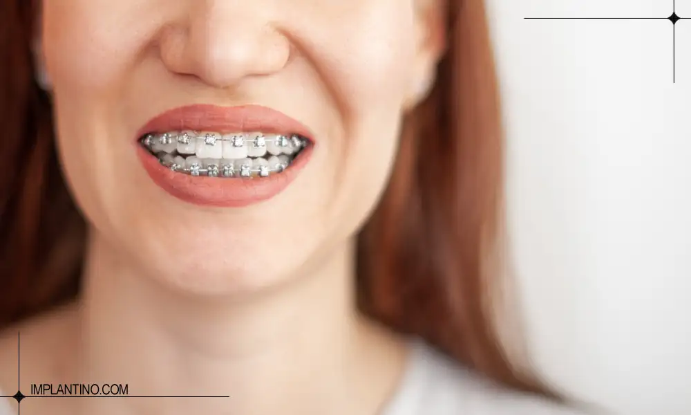 ارتودنسی دندان ایمپلنت شده