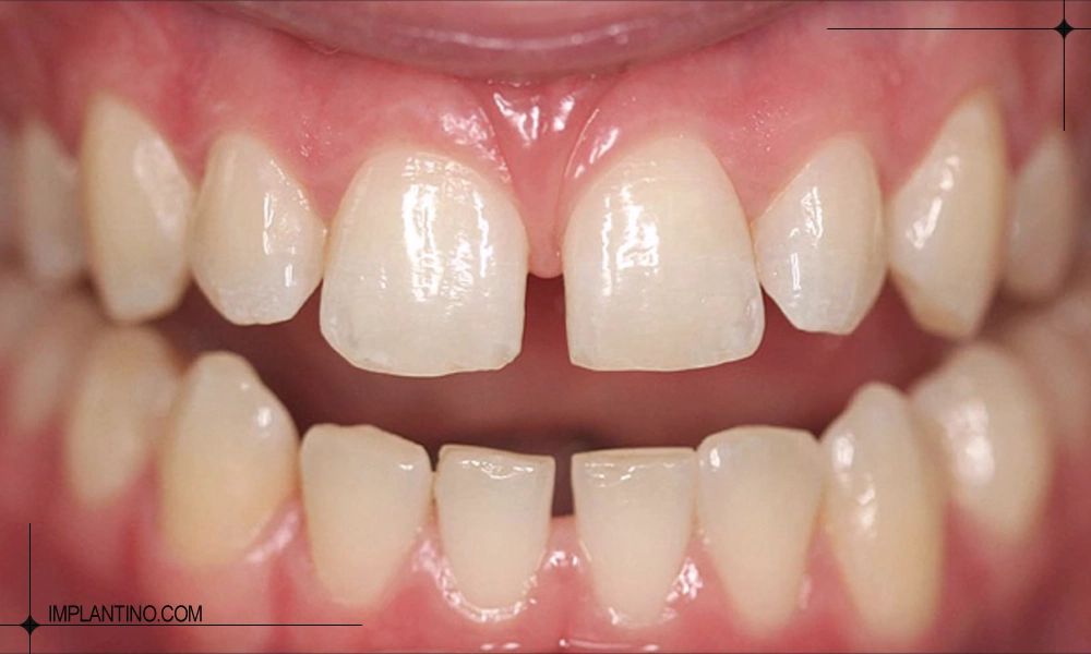 راه های از بین بردن فاصله دندان در کلینیک و خانه 3 فاصله دندان در بزرگسالان
