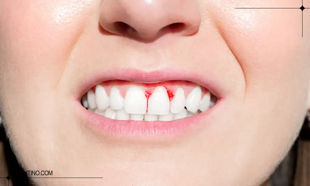 دلیل خونریزی لثه هنگام مسواک زدن 3 خون روی لثه های یک خانم در اثر خونریزی لثه هنگام مسواک زدن