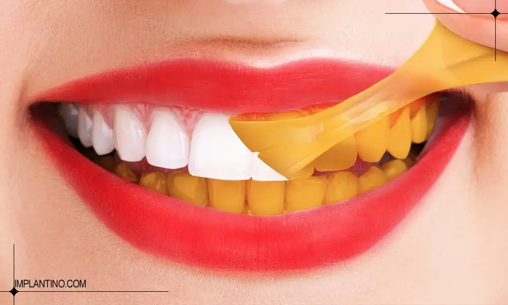 آشنایی دلایل زرد شدن دندان 3 زرد شدن دندان و راه های از بین بردن آن