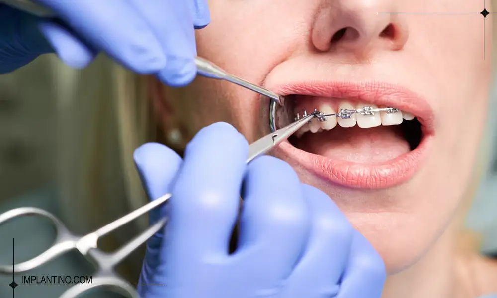 سفت کردن ارتودنسی دندان ایمپلنت شده