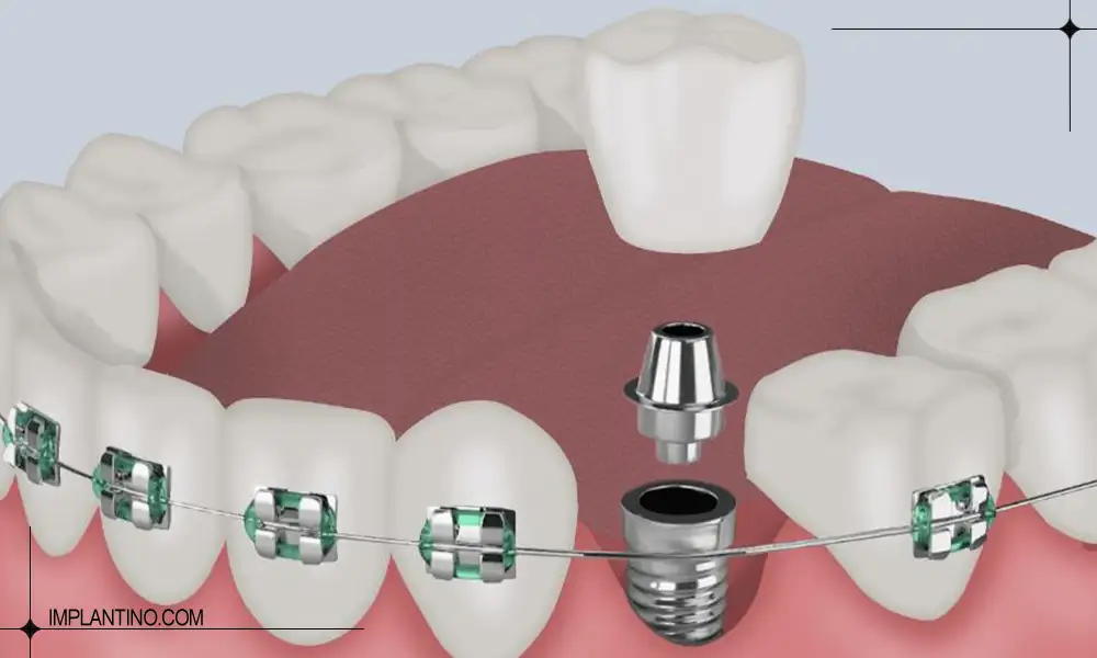 ارتودنسی دندان ایمپلنت شده در حین کاشت