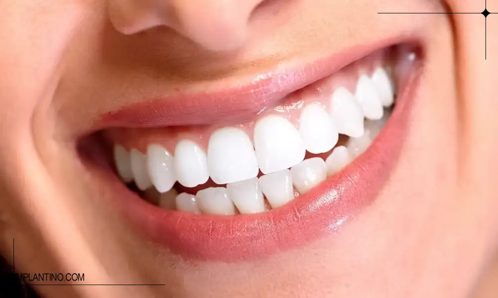 آشنایی با راه های تقویت مینای دندان 1 دندان های تمییز و براق بعد از تقویت مینای دندان