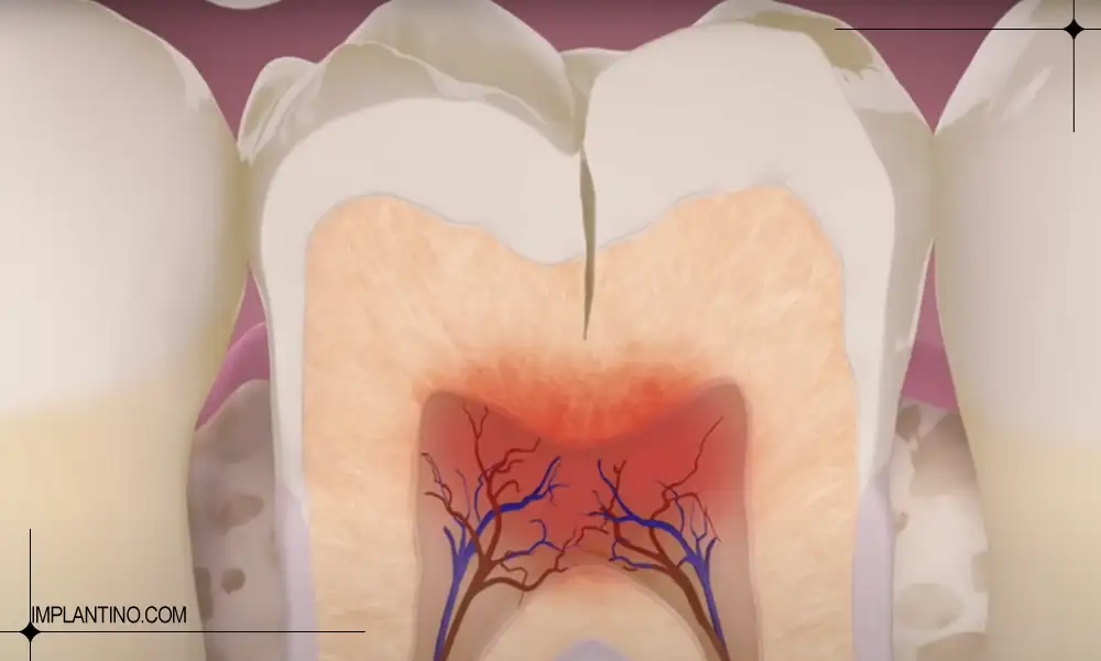 دلیل ترک دندان و راه ترمیم آن 3 ترک دندان که نزدیکه به عصی و ریشه دندان شده است.