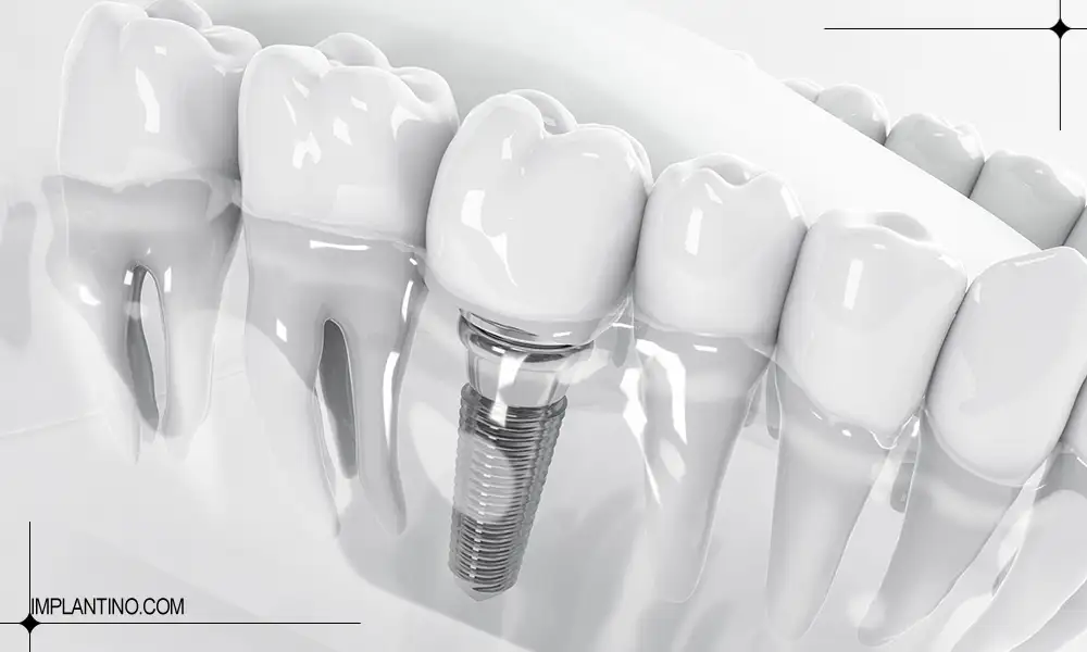 بهترین دکتر ایمپلنت شرق تهران کیست؟ 3 استفاده ار جدیدترین ابزار کاشت دندان با کمک بهترین دکتر ایمپلنت شرق تهران