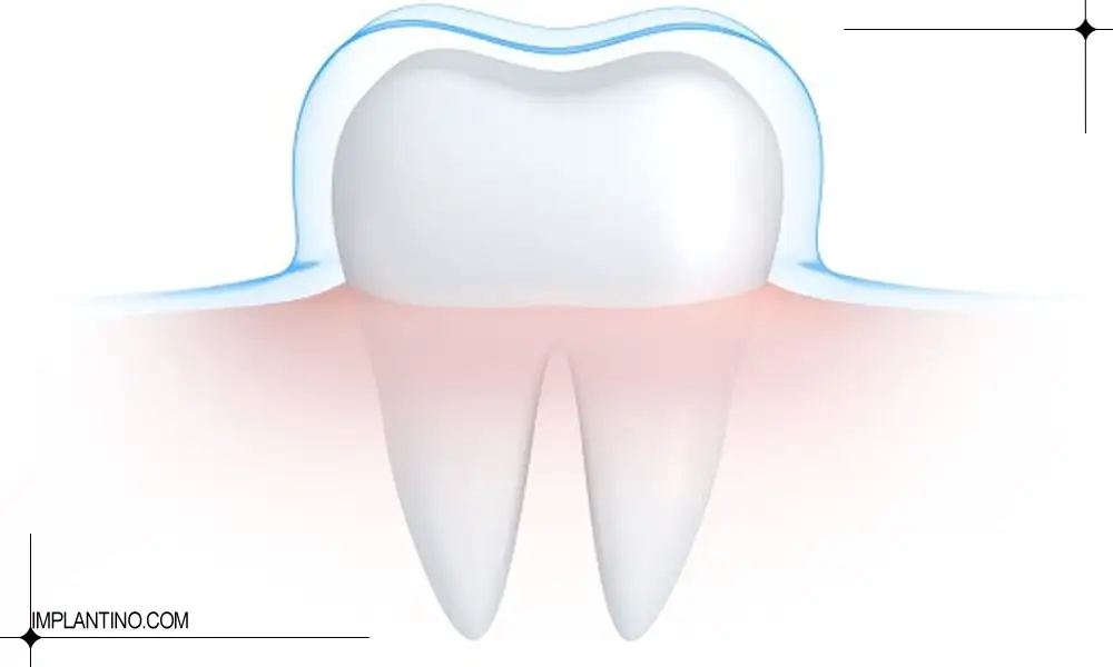 آشنایی با راه های تقویت مینای دندان 3 تقویت مینای دندان