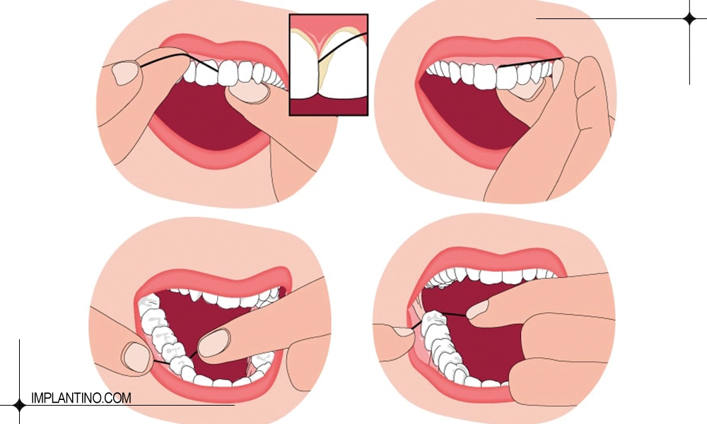 آشنایی با نحوه صحیح نخ دندان کشیدن 2 عکس نحوه نخ دندان کشیدن