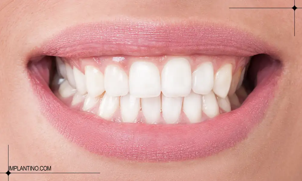 انتخاب رنگ کامپوزیت دندان برای زیبایی لبخند 3 سفیدترین رنگ کامپوزیت دندان