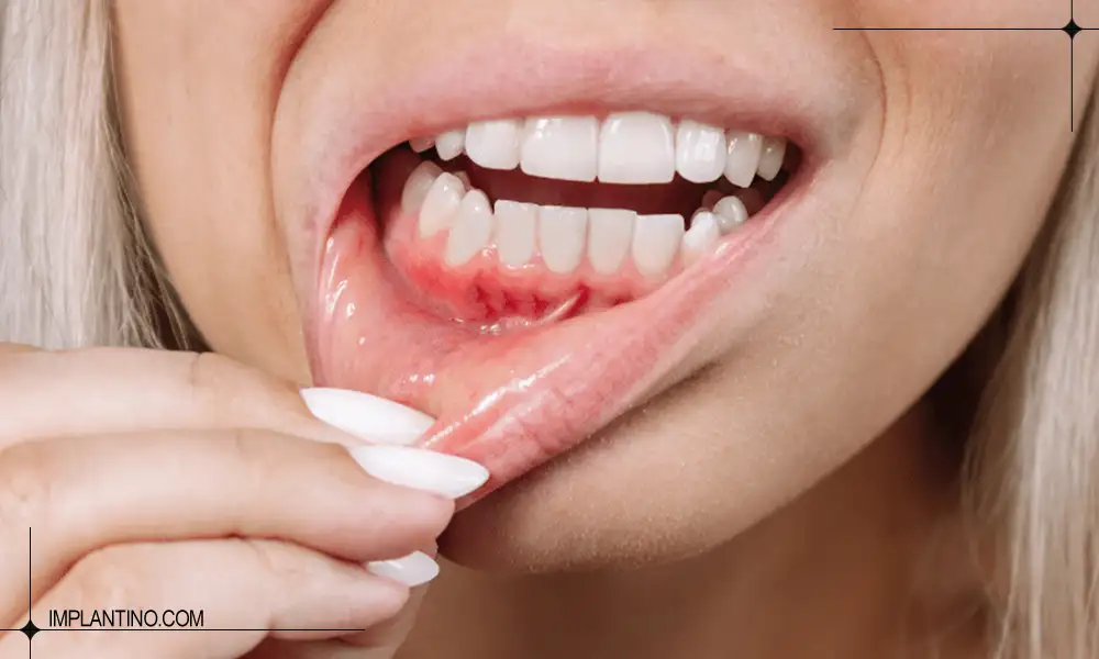 شکل تیرگی لثه