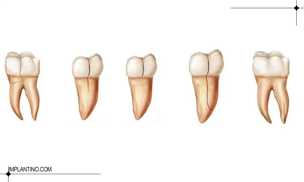 دلیل ترک دندان و راه ترمیم آن 2 عکی انواع ترک دندان