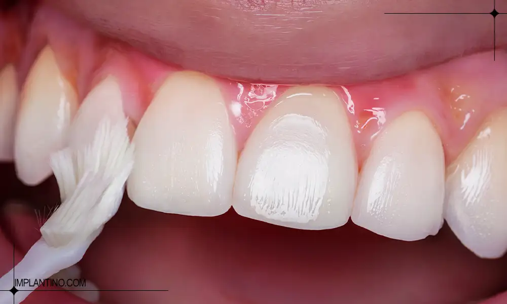 آشنایی با راه های تقویت مینای دندان 2 تقویت مینای دندان با فلوراید