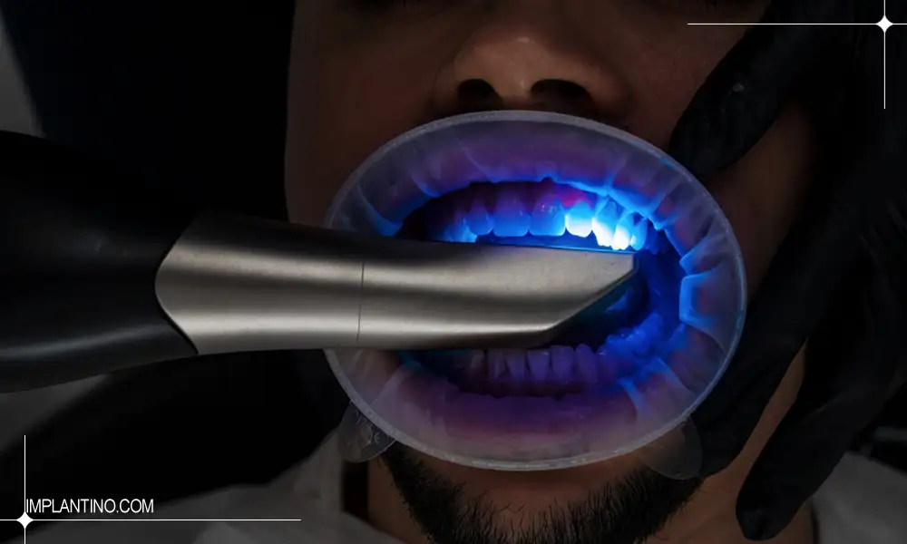 معرفی اسکنر داخل دهانی و کاربردهای آن 1 نور اسکنر داخل دهانی داخل دهان بیمار آقا