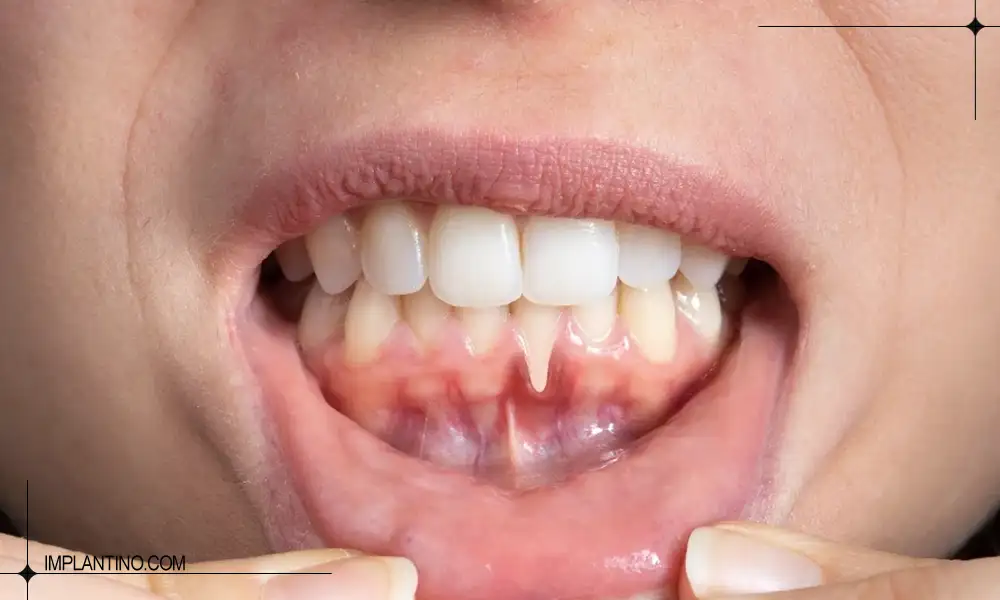 تیرگی لثه در فک پایین