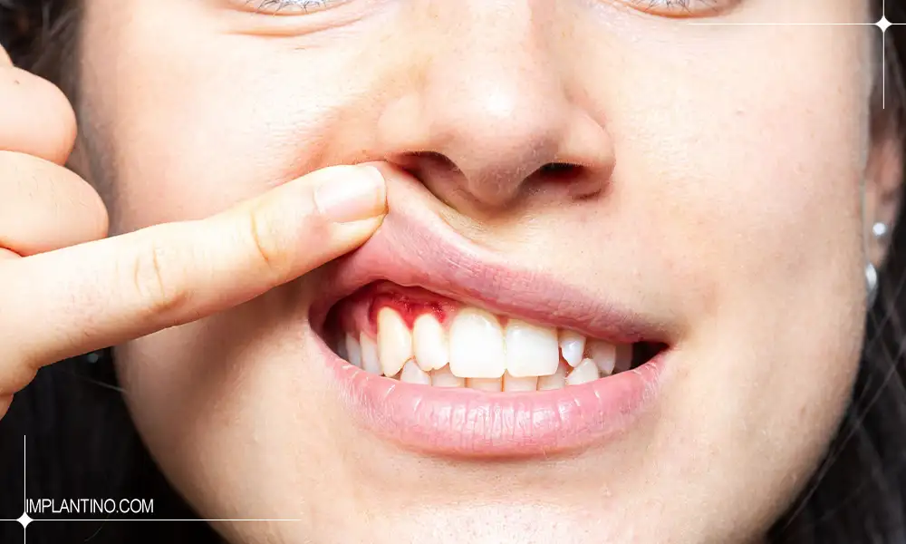 شکل بیماری لثه