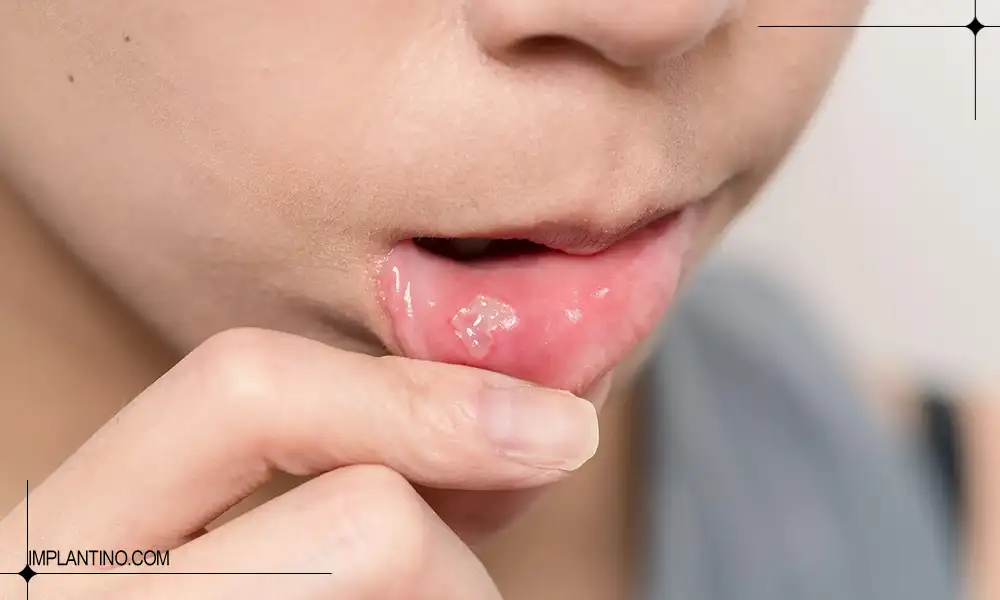 آفت دهان داخل دیواره دهان