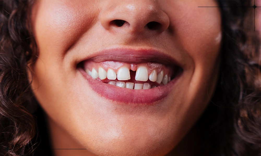 راه های از بین بردن فاصله دندان در کلینیک و خانه 1 فاصله دندان های جلو یک خانم