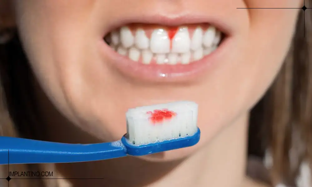 دلیل خونریزی لثه هنگام مسواک زدن 1 جای ماندن خون روی مسواک به دلیل خونریزی لثه هنگام مسواک زدن