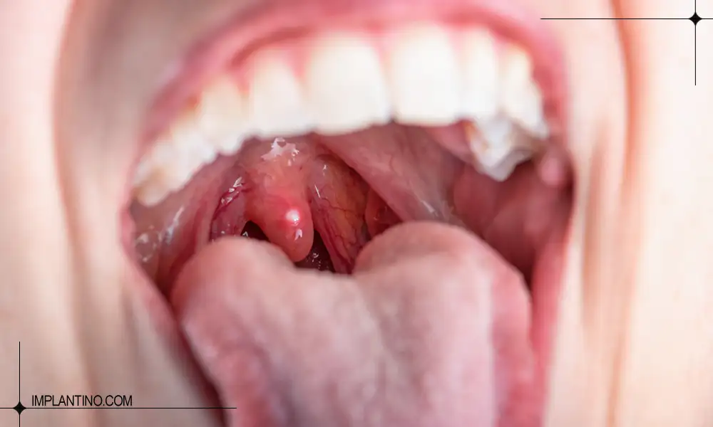 عکس خشکی دهان