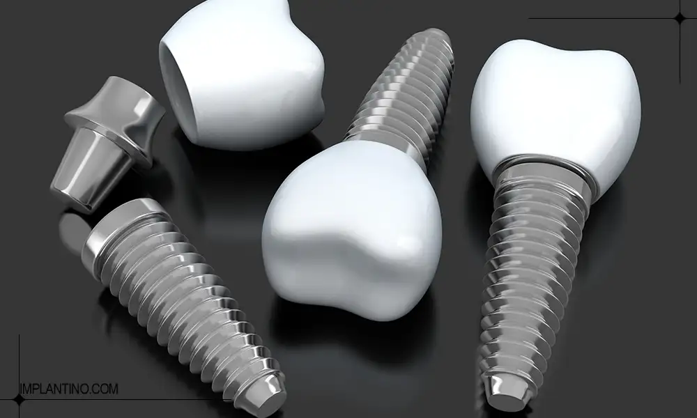 مزایای ایمپلنت دندان و کاشت آن