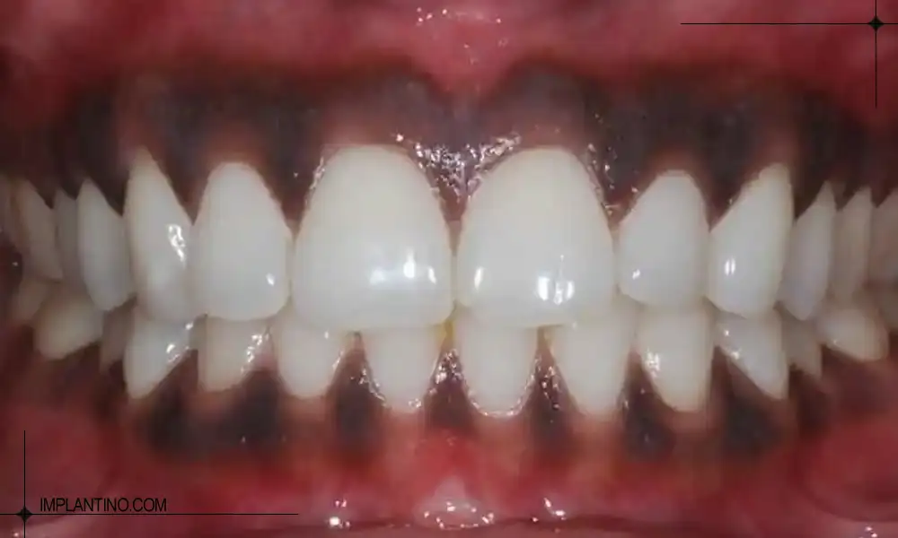 عکس تیرگی لثه های فک بالا و پایین