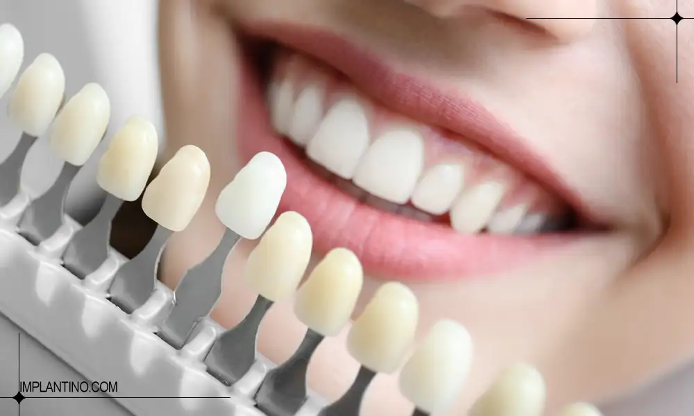 متقاضی خانم در حال انتخاب رنگ کامپوزیت دندان