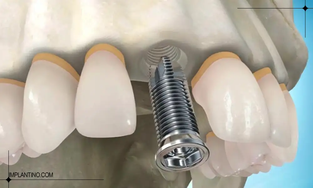 شکستن ایمپلنت بعد از کاشت دندان