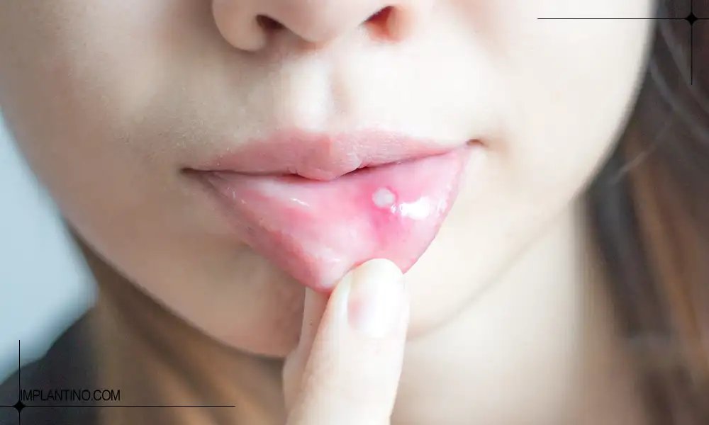 عکس آفت دهان