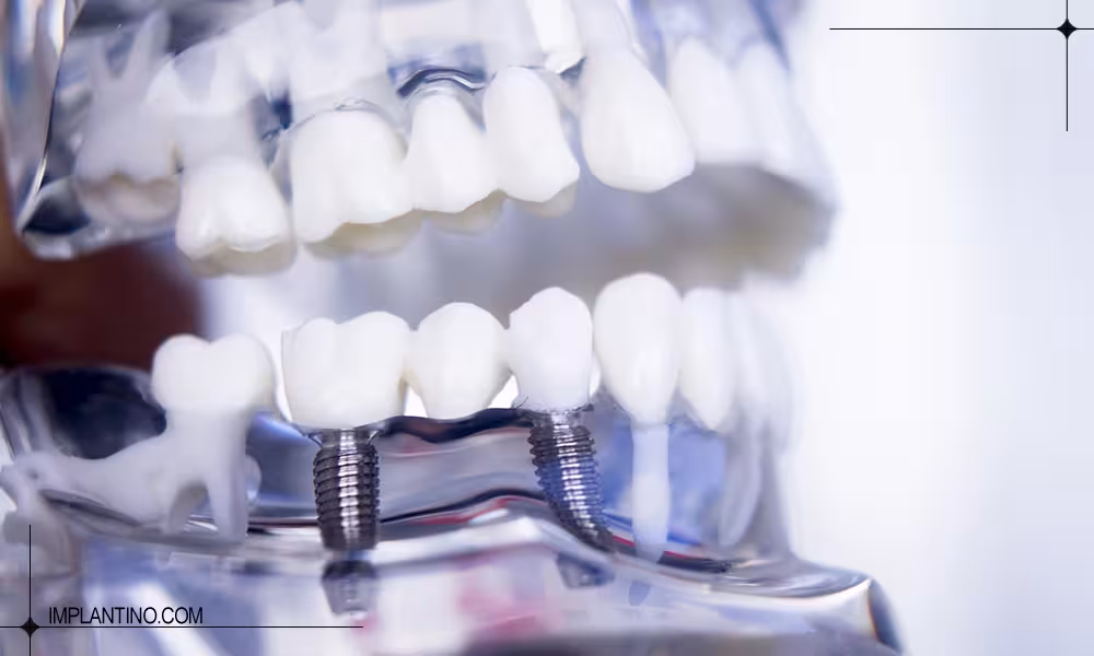 جرم گیری ایمپلنت دندان امکانپذیر است؟ 2 کاشت دندان روی ماکت فک بالا و پایین و جرم گیری ایمپلنت دندان