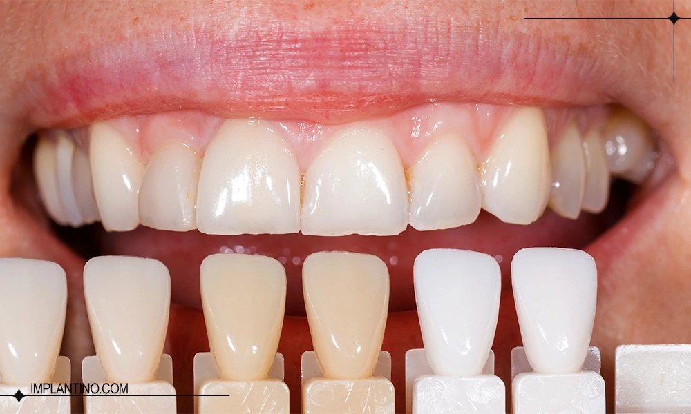 میزان ماندگاری کامپوزیت دندان چقدره؟ 3 شکل و رنگ کامپوزیت دندان | ماندگاری کامپوزیت دندان