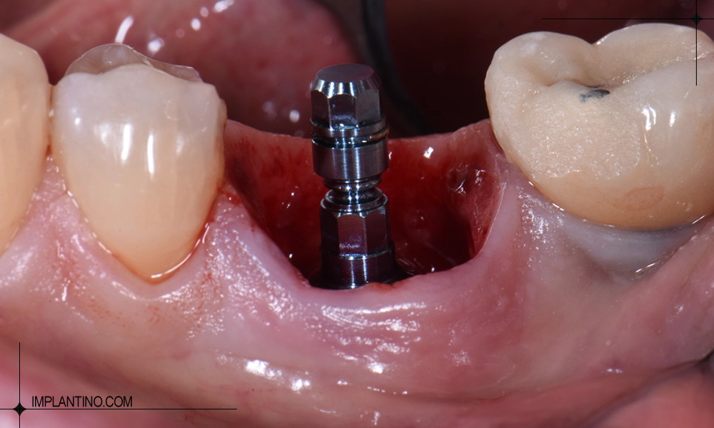 کاشت فیکسچر در مراحل ایمپلنت دندان