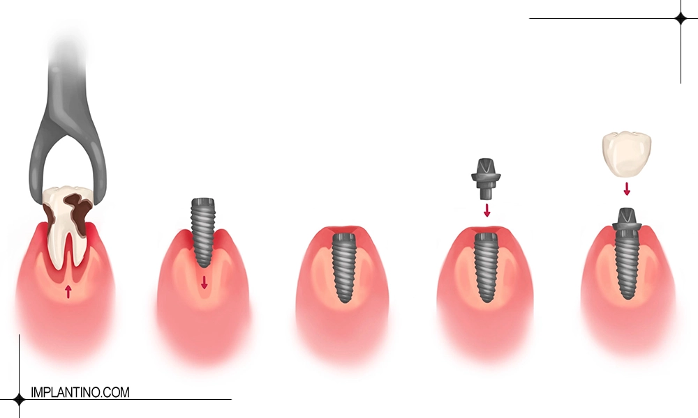 مراحل ایمپلنت دندان از کشیدن تا کاشت
