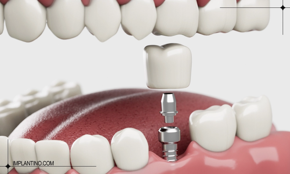 کاشت دندان با ایمپلنت