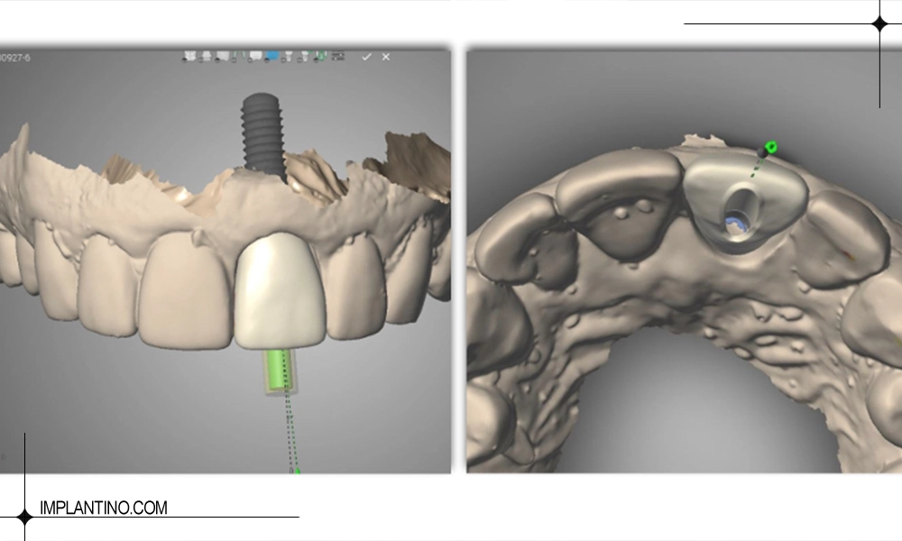 مراحل ایمپلنت دندان دیجیتال