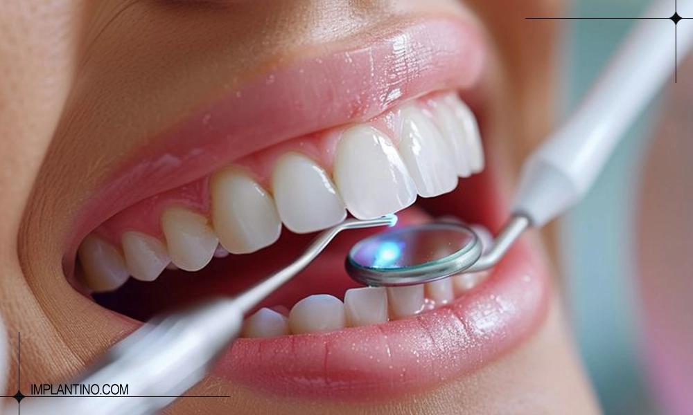 میزان ماندگاری کامپوزیت دندان چقدره؟ 1 چک کردن کامپوزیت توسط پزشک | ماندگاری کامپوزیت دندان