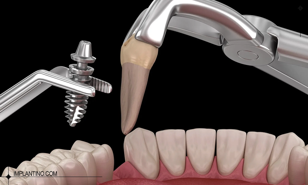 مراحل ایمپلنت دندان فوری