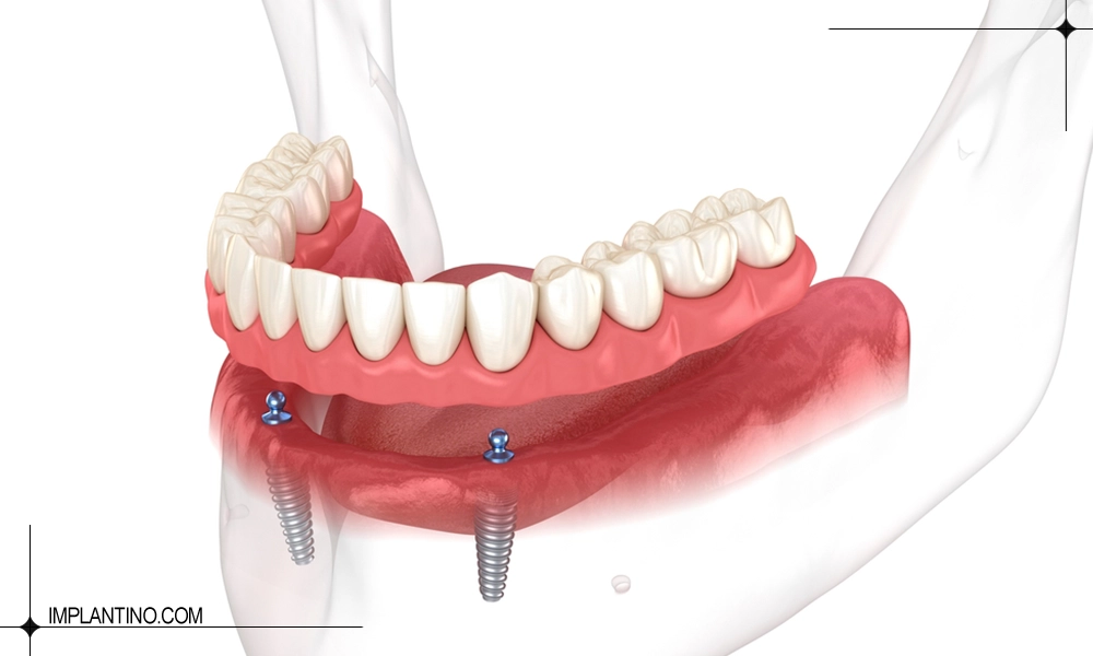 دندان مصنوعی بر پایه ایمپلنت