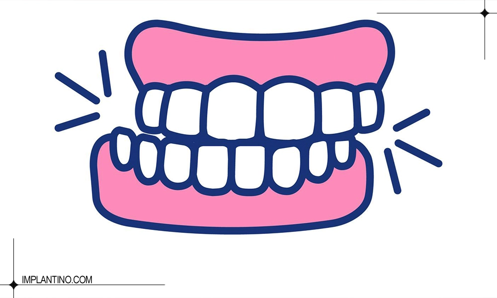 تأثیر دندان قروچه بر ایمپلنت دندان چیست؟ 1 دندان قروچه بر ایمپلنت