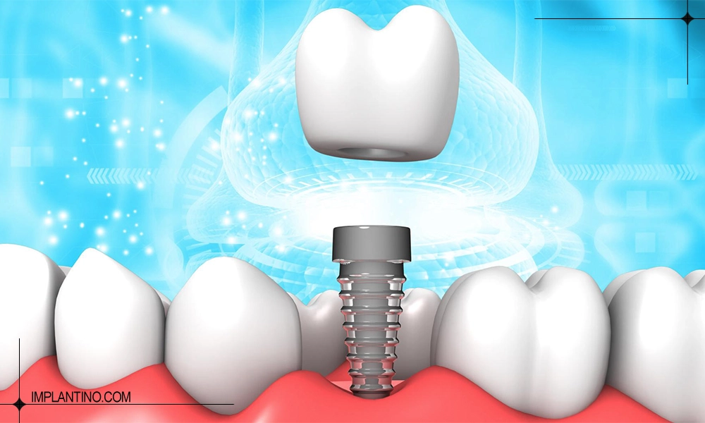 دوره نقاهت ایمپلنت و راه های بهبود سریع