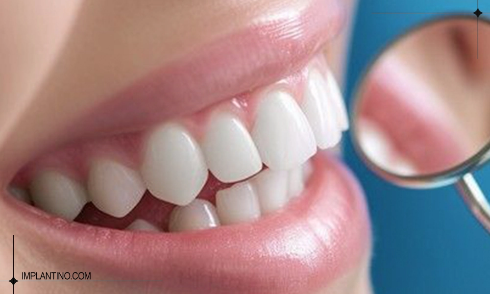 میزان ماندگاری کامپوزیت دندان چقدره؟ 2 دندانهای زیبا و یکدست بعد از کامپوزیت | ماندگاری کامپوزیت دندان