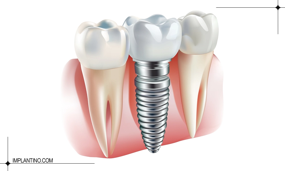 تأثیر دندان قروچه بر ایمپلنت دندان چیست؟ 3 دندان قروچه بر ایمپلنت دندان نصب شده
