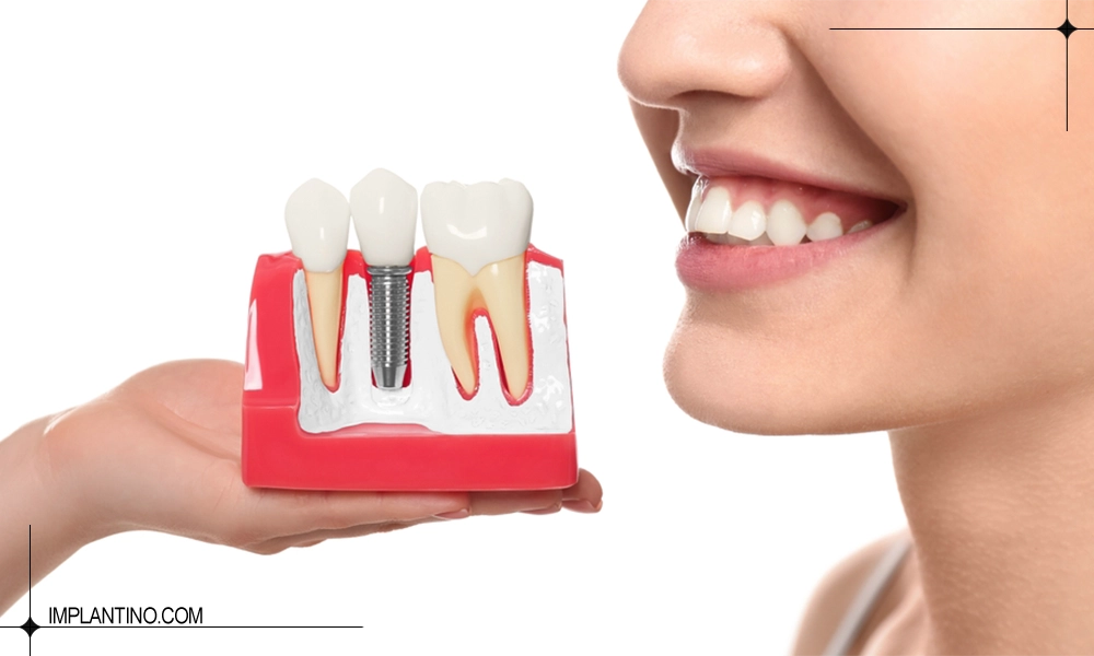 انتخاب و انجام کاشت دندان در مرکز ایمپلنت در تهران