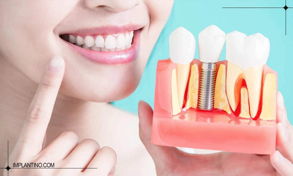 ایمپلنت دندان و خانمی با کاشت ایمپلنت