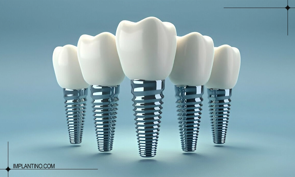 معرفی ایمپلنت ایرانی