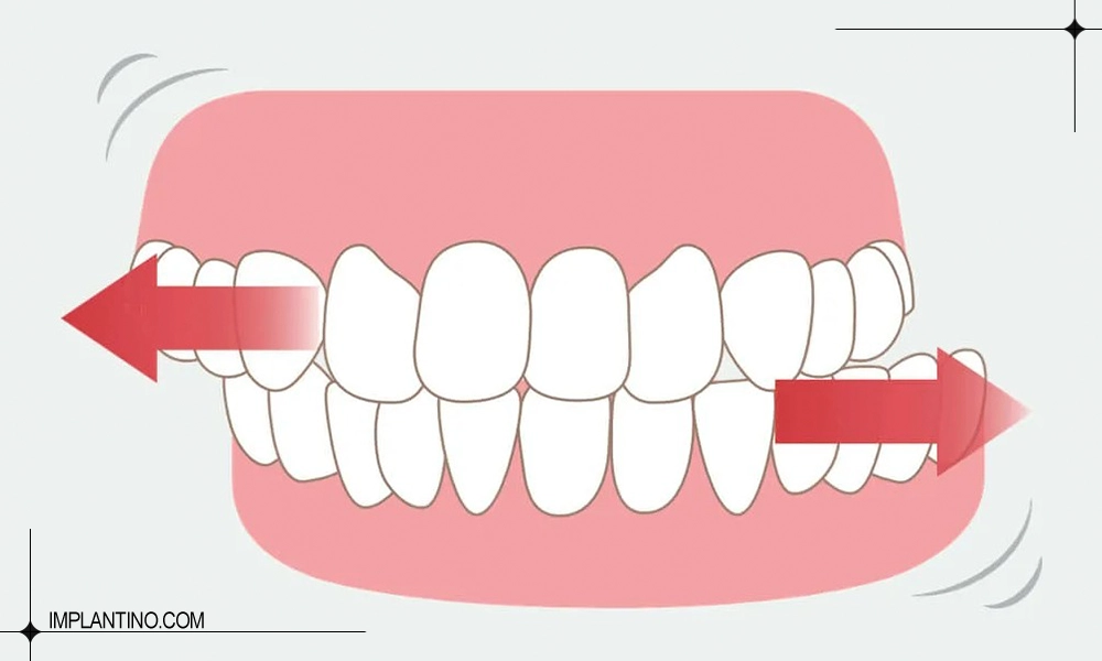 دندان قروچه یا ساییدن دندان چه زمانی اتفاق می افتد؟ 1 دندان قروچه چه شکلی است؟
