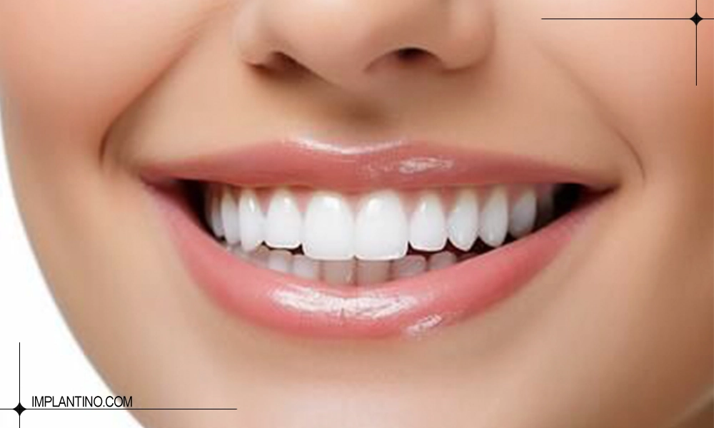 عکس کامپوزیت در ماندگاری کامپوزیت دندان