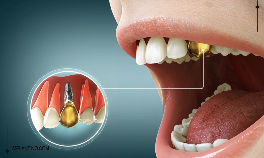 کاشت روکش طلا در ایمپلنت طلا