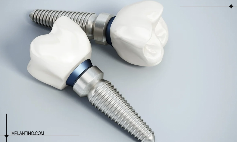 نمونه ایمپلنت ایرانی