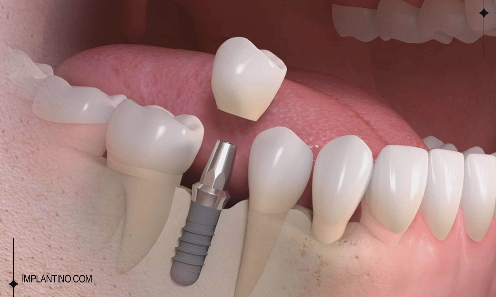 کاشت ایمپلنت در دندان قروچه بر ایمپلنت