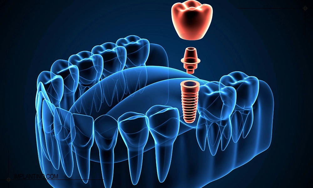 بررسی تفاوت ایمپلنت دیجیتال و معمولی از هر نظر 2 ایمپلنت دیجیتال و معمولی
